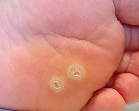 wart-removal-side-img