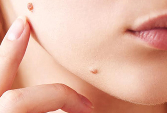 wart_removal_featured_img
