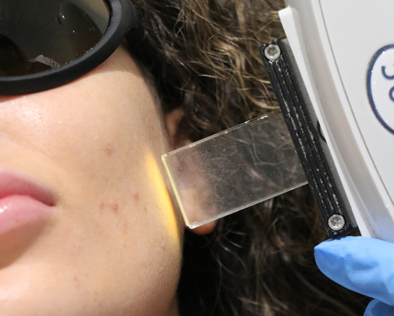 laser_acne_treatment_side_img_1
