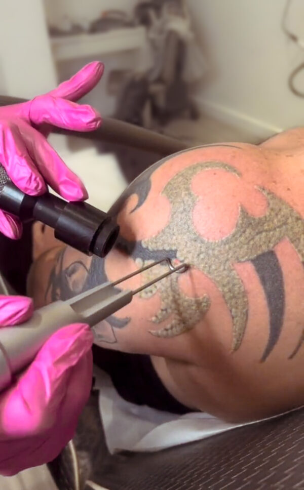 Tattoo Removal Process