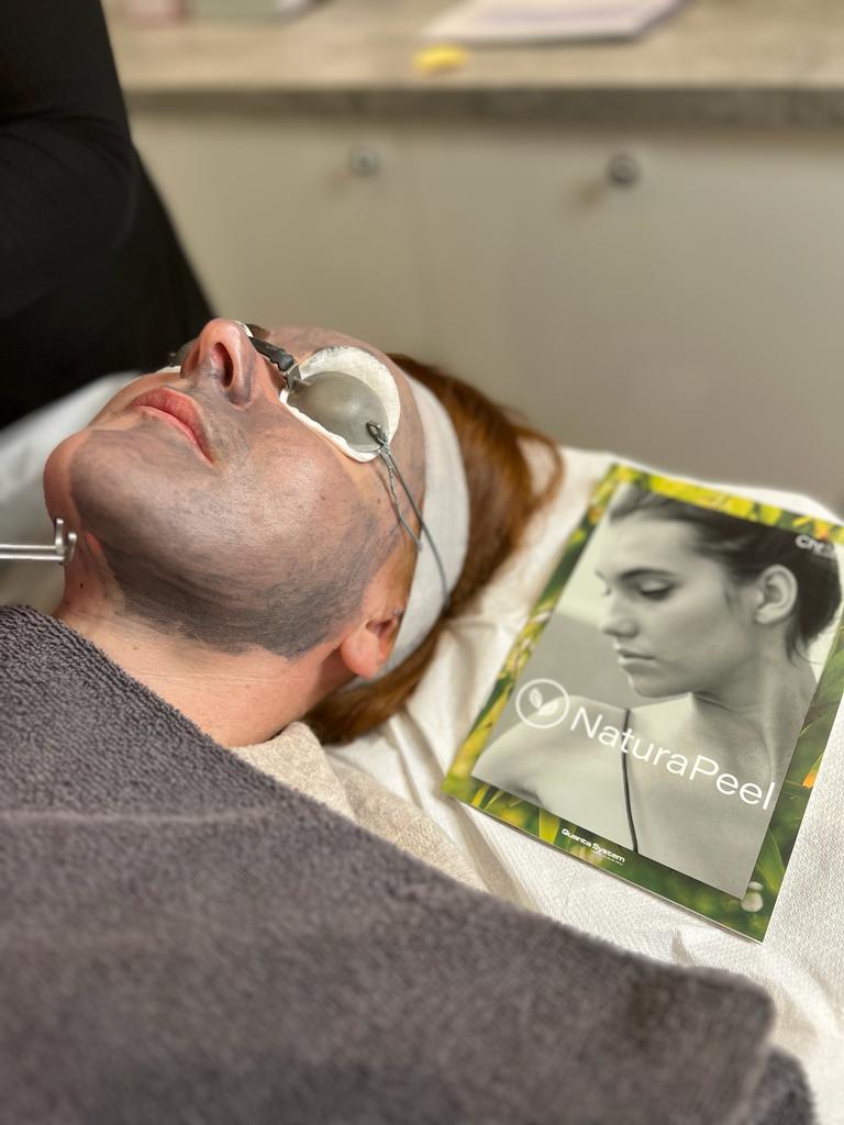 NaturaPeel Carbon Laser Peel