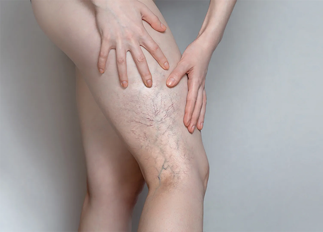 spider vein treatment