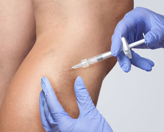 Microsclerotherapy Treatment In Stoke-on-Trent & Staffordshire
