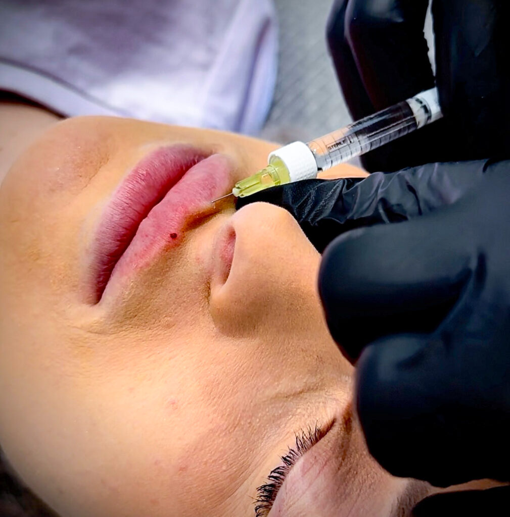 lip filler Lip Filler Staffordshire