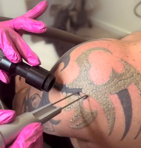 Local tattoo removal Staffordshire