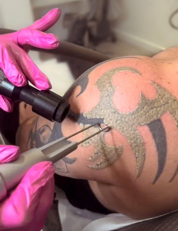 Local tattoo removal Staffordshire