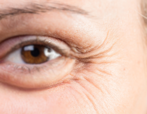 Anti Wrinkle Botox Injections