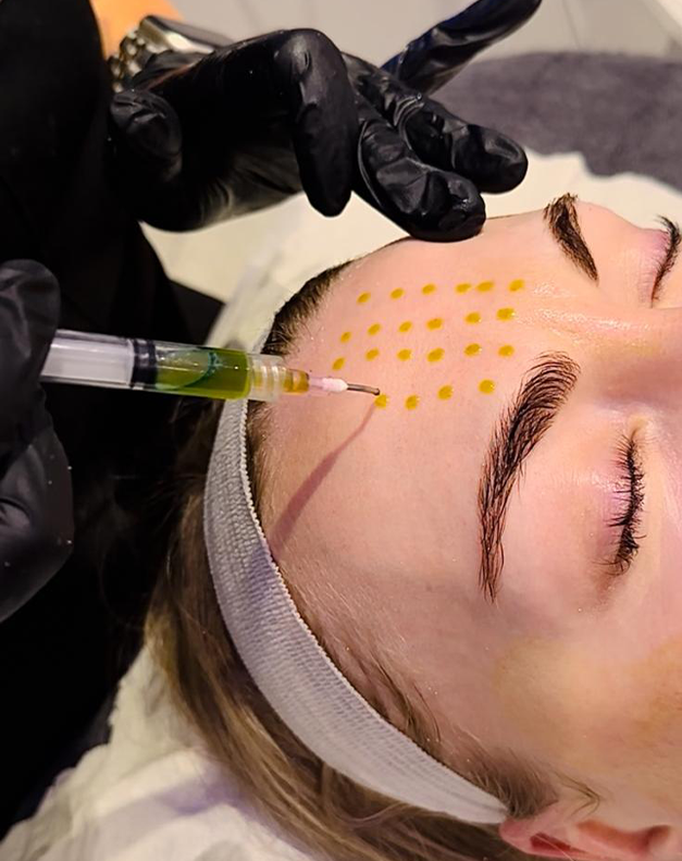 chemical peel