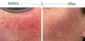 rosea before and after – mobile 2