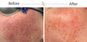 rosea before and after – mobile