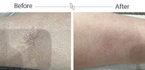 vein removal before and after – mobile 1