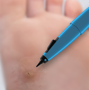 Verucca and Wart Removal