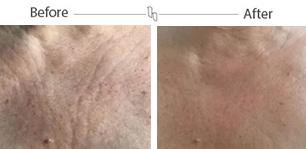 Microneedling – Before and After – Mobile